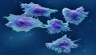 Colorectal cancer