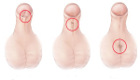 Hypospadias