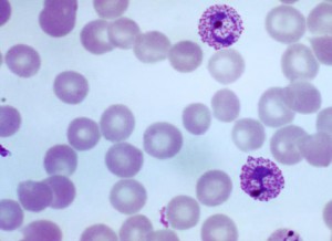 malaria